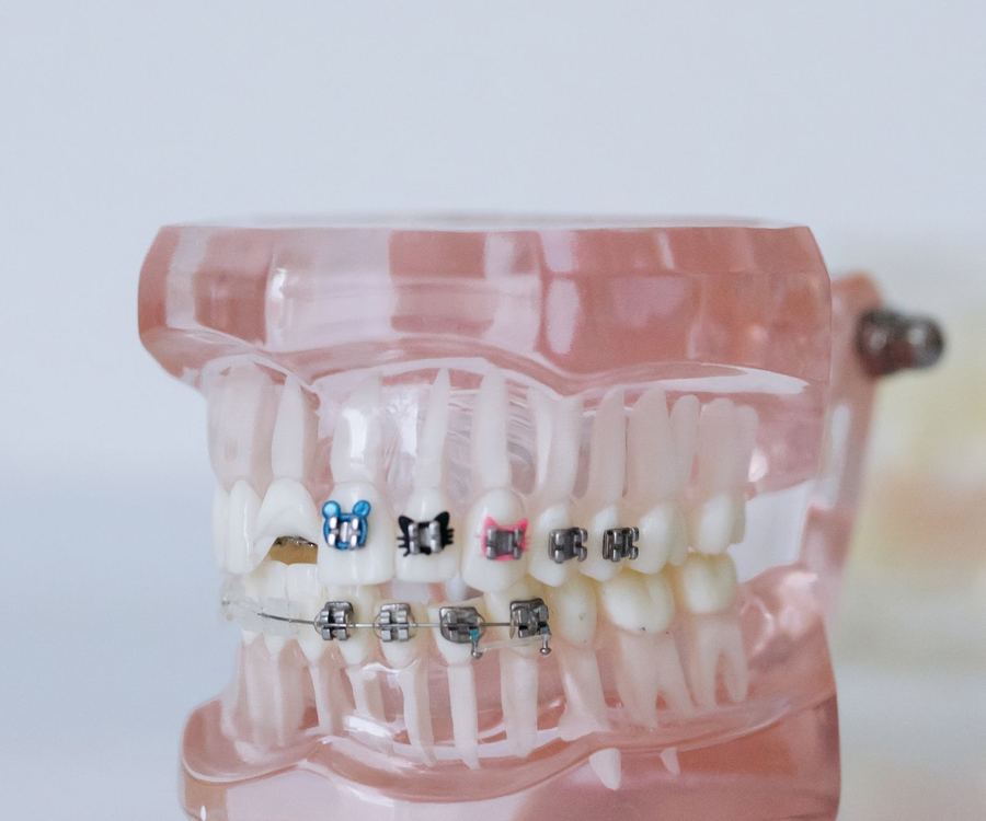 Close-up of an orthodontic model showing metal braces brackets and wire on the teeth